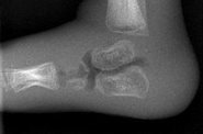 'Phantom' foot improves baby X-rays